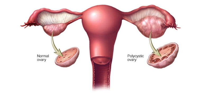 PCOD-and-PCOS